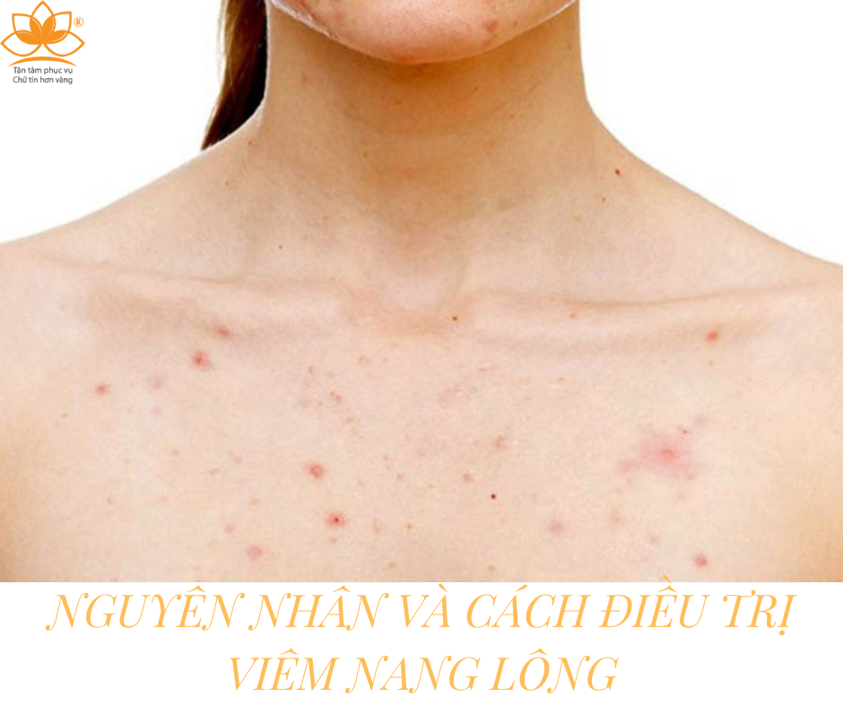 1. Viêm nang lông là gì?